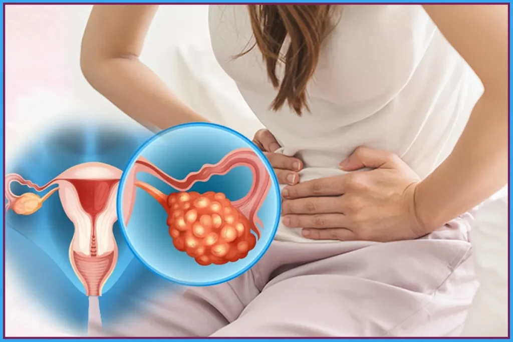 PCOS symptoms and management