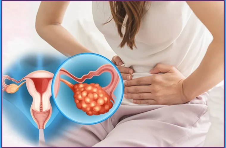 PCOS symptoms and management